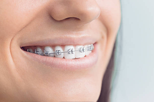 Best Teeth Whitening  in Saunders Lake, OR